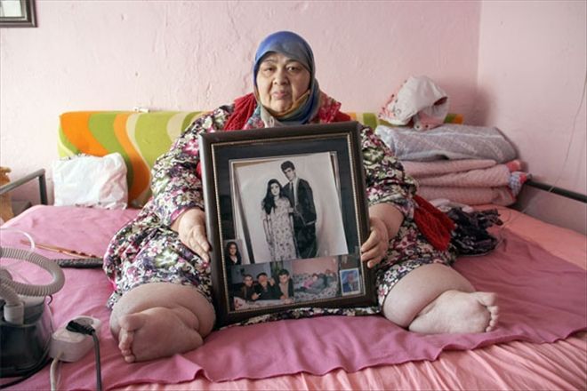 Kilo verebilmek için yardım bekliyor