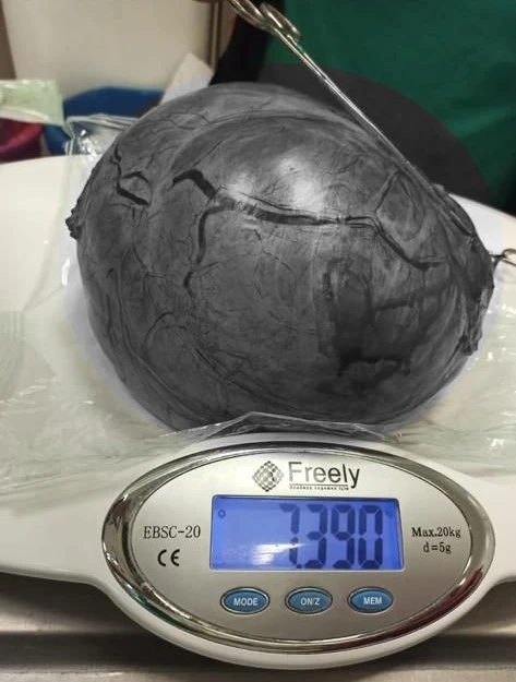 Kilo Aldığını Zannetti, Karnından 7 Kilo 390 Gram Kitle Çıktı