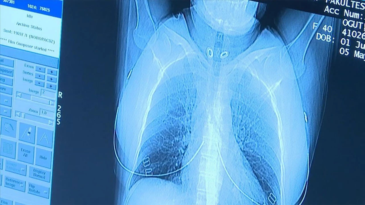 'Düşük doz akciğer tomografisi' ile akciğer kanserinde erken teşhis mümkün