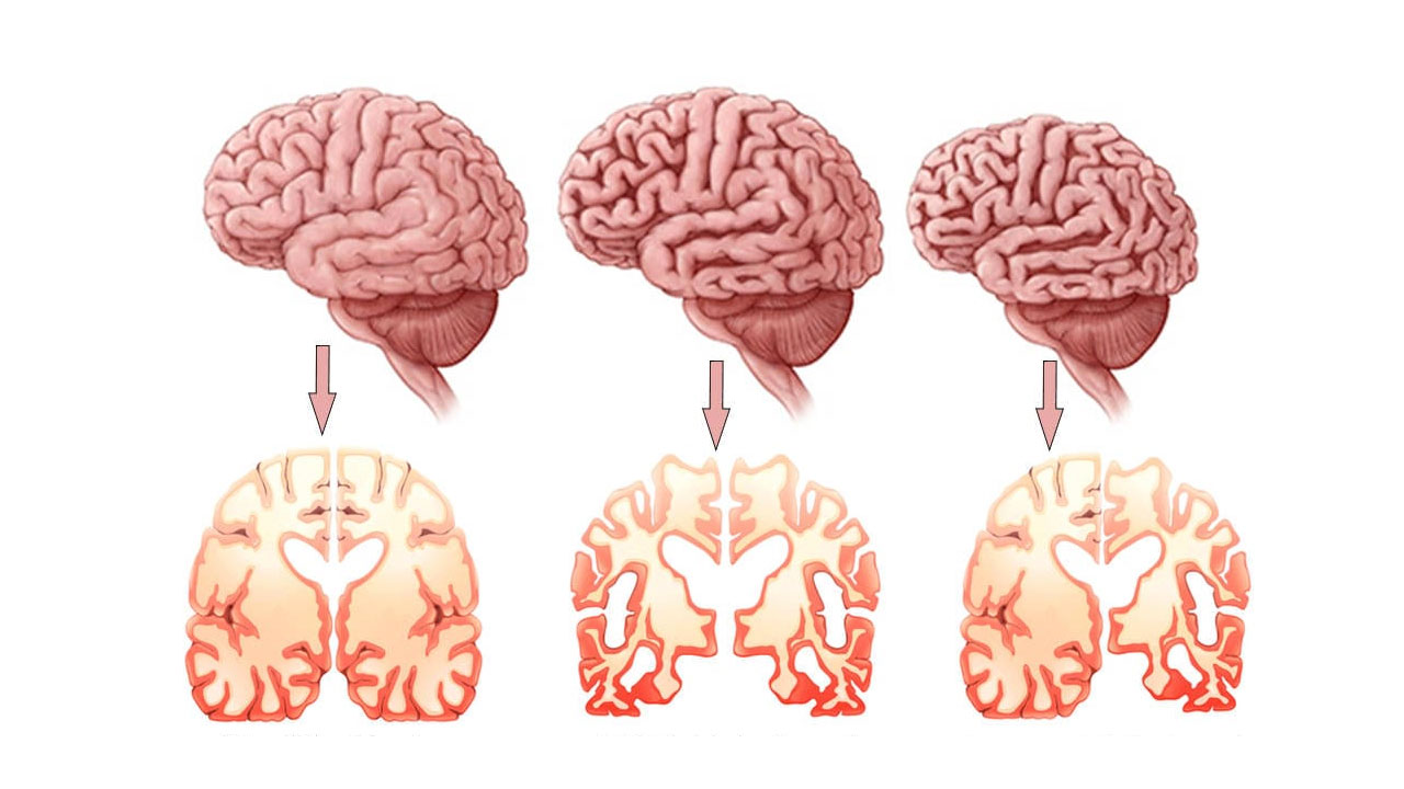 'Alzheimerdan korunmak mümkün’