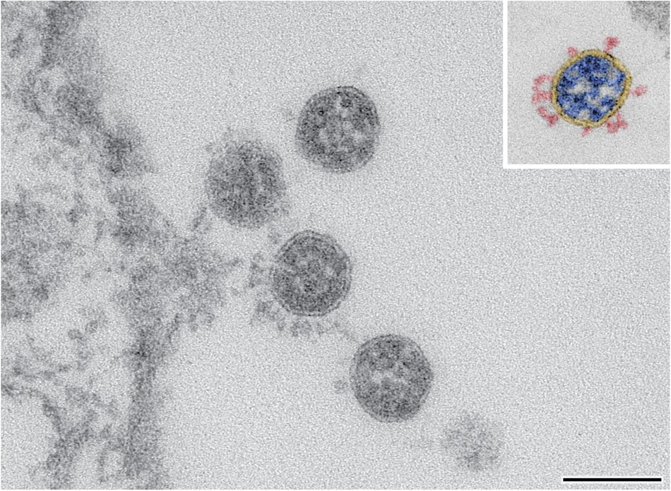 Yeni ‘Frankenstein’ COVID-19 Varyantı Nedir? XFG Hakkında Bilmeniz Gerekenler