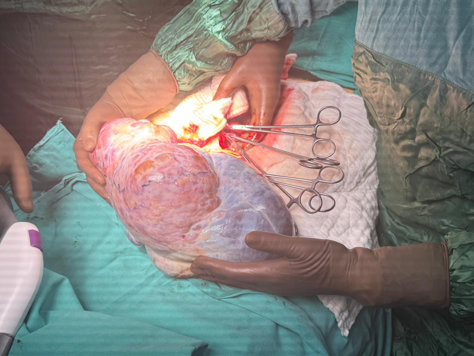 Şişkinlik ve halsizlik şikayetiyle doktora gitti karnından 5 kilo çıktı!