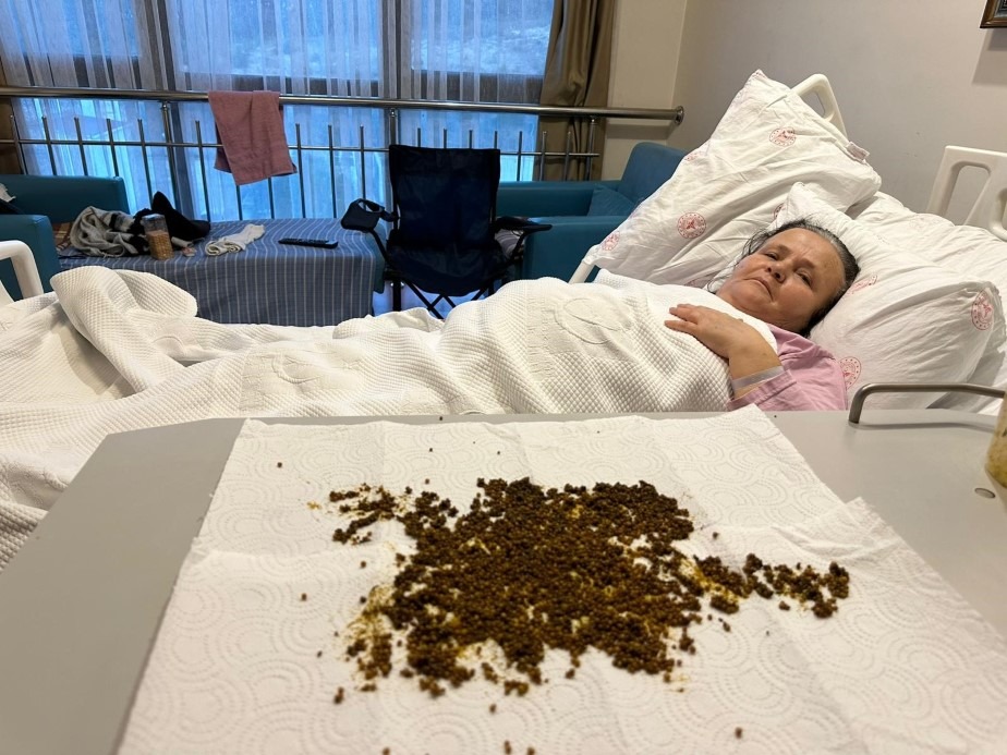 Safra kesesinden 20 binin üzerinde taş çıkarıldı