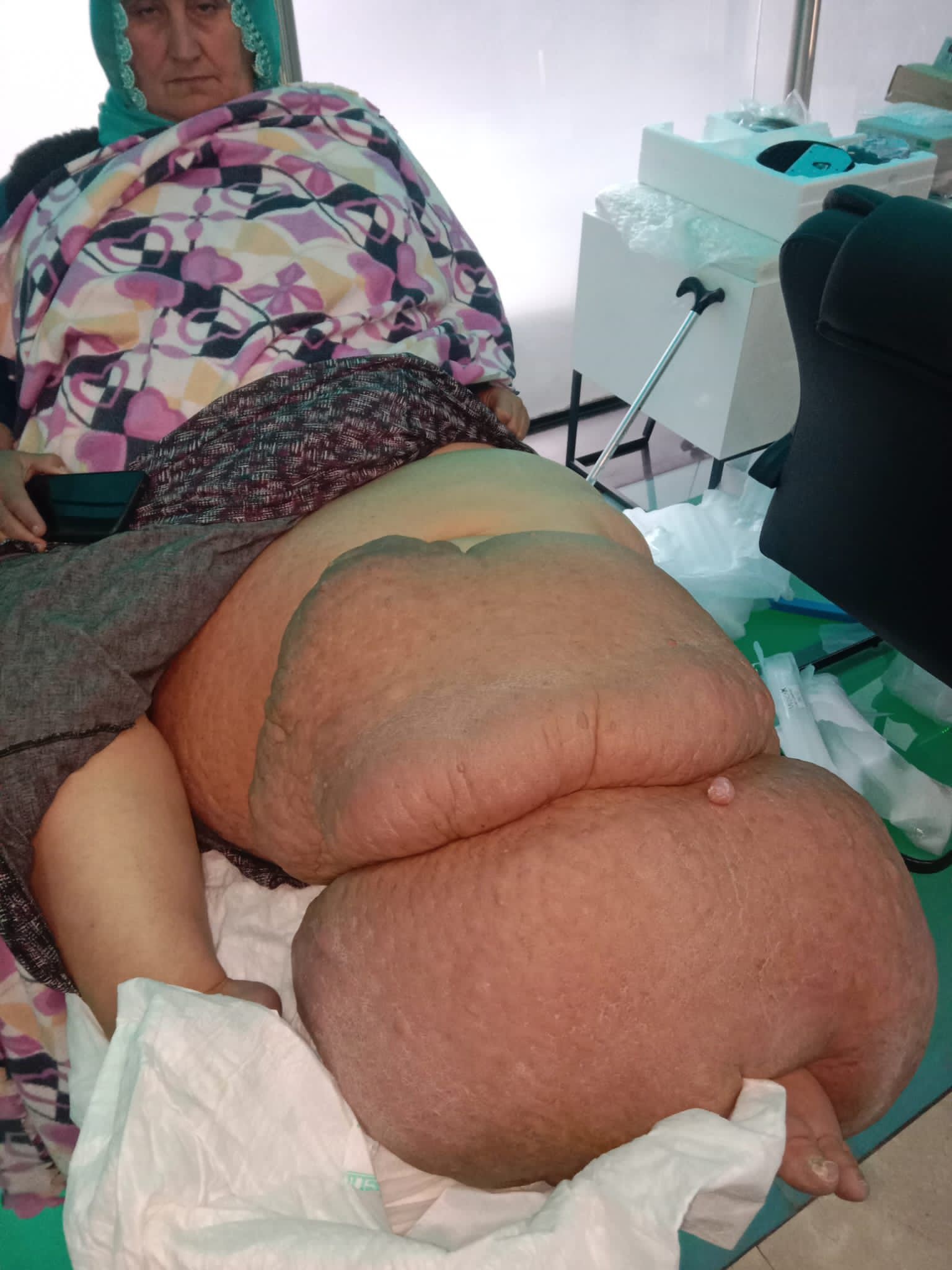 35 yıldır fil hastalığıyla mücadele ediyor