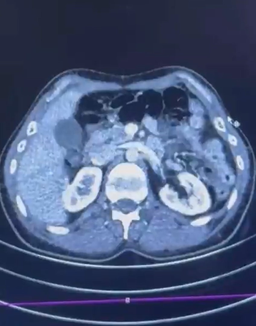 Midelerinde uyuşturucuyla ülkeye girmeye çalıştılar