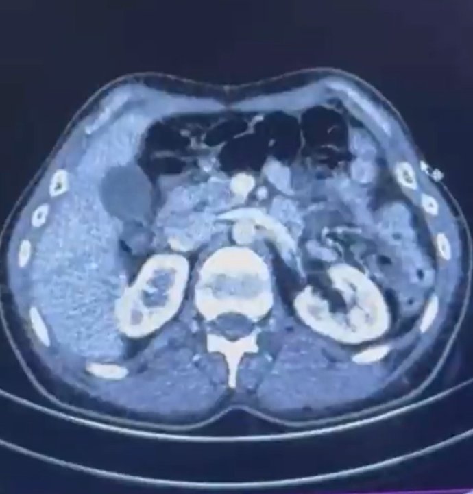 Midelerinde uyuşturucuyla ülkeye girmeye çalıştılar