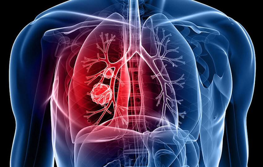 Sivas Verem Savaş Dispanserinden hayati çağrı!