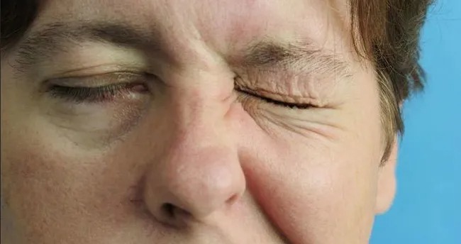 "Yüz felcinde erken müdahale kalıcı hasarı önlüyor"