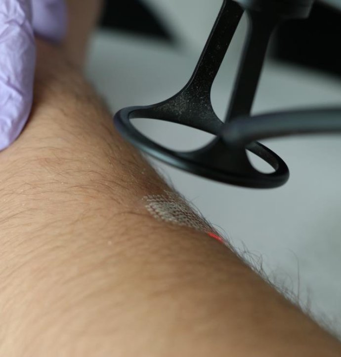 Estetik lazer uygulamalarında en doğru zaman