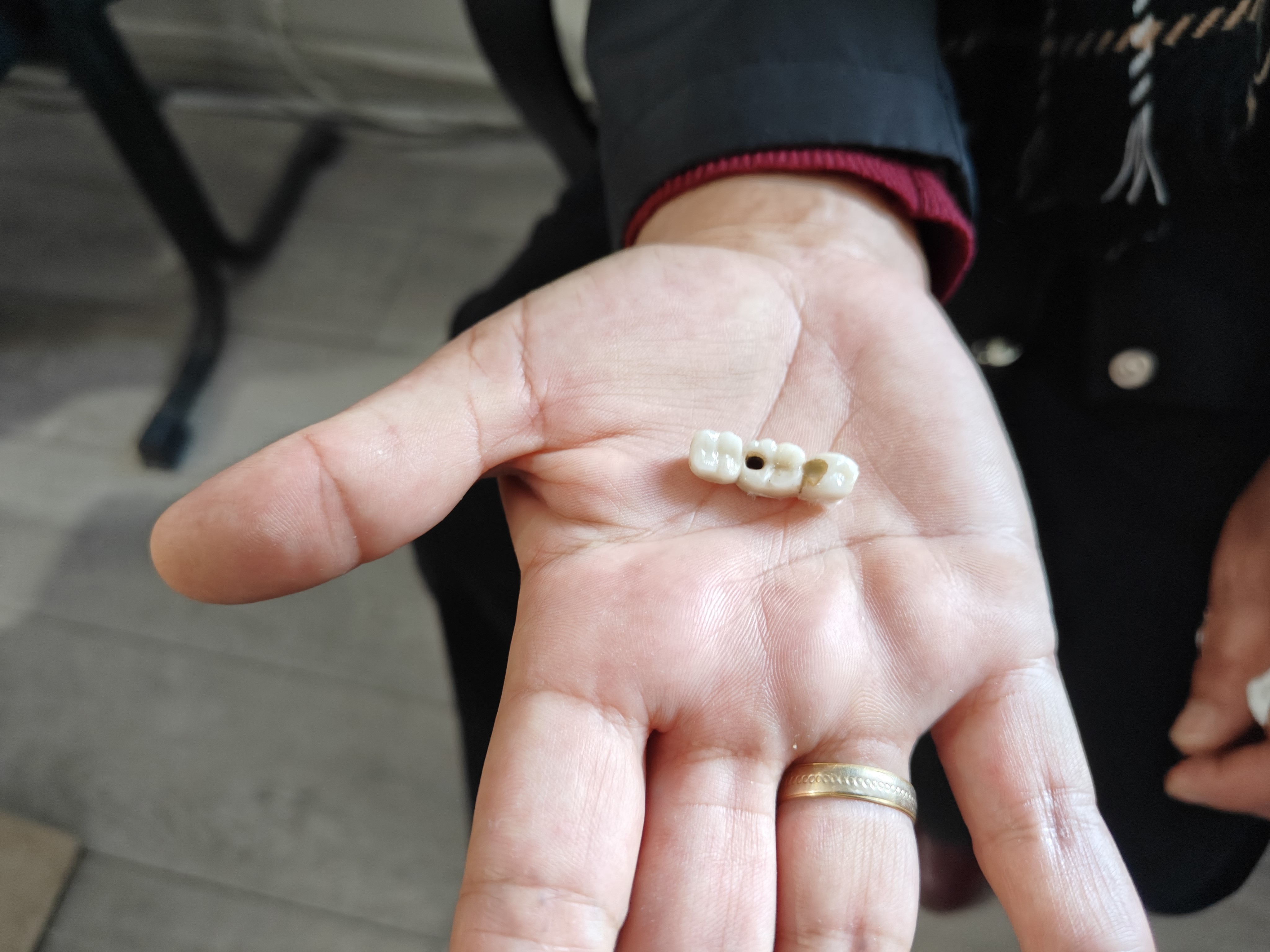 İmplant elinde hasta şikayette