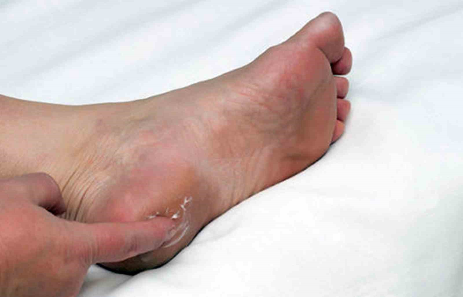 Uzmanından topuk dikeni uyarısı