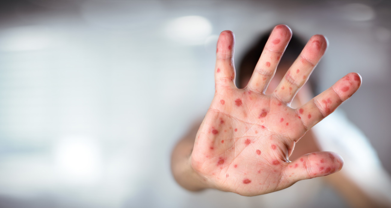 Uzmanı açıkladı! Aşı karşıtlığı o hastalıkta ölümcül sonuçlar doğurabiliyor