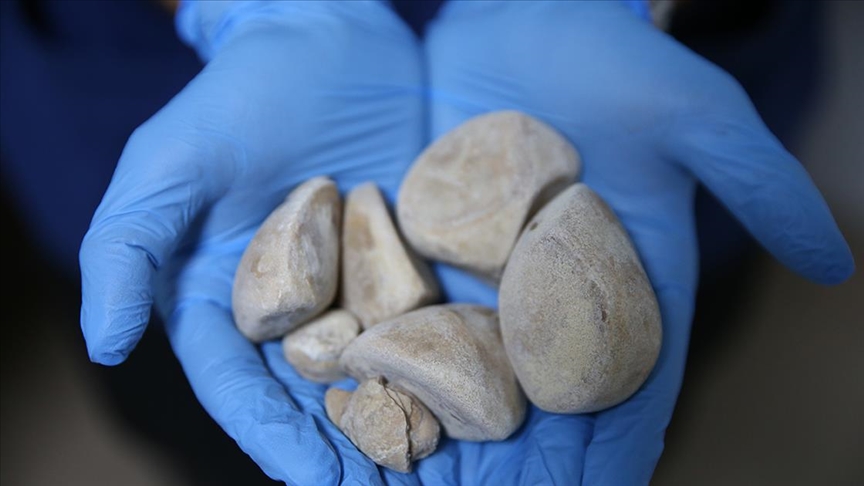 İdrar kanalı ve mesanesinden yarım kilogram taş çıktı