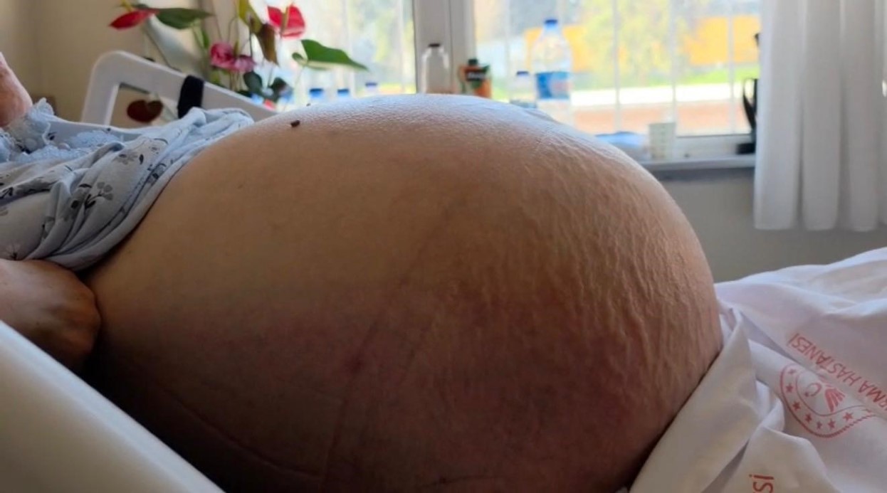 Kabızlık diye düşündü, 22 kilo tümör çıktı