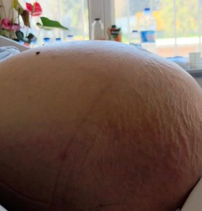 Kabızlık diye düşündü, 22 kilo tümör çıktı