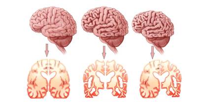 'Alzheimerdan korunmak mümkün’