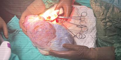 Şişkinlik ve halsizlik şikayetiyle doktora gitti karnından 5 kilo çıktı!