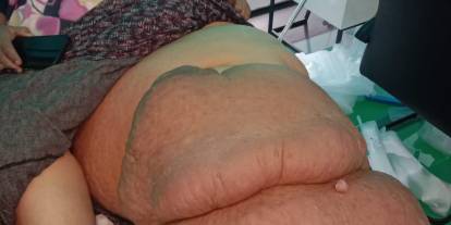 35 yıldır fil hastalığıyla mücadele ediyor