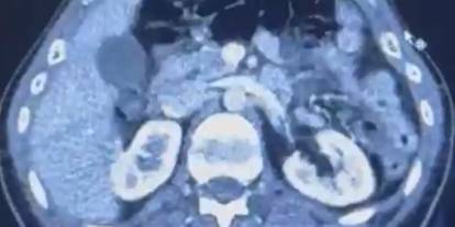 Midelerinde uyuşturucuyla ülkeye girmeye çalıştılar