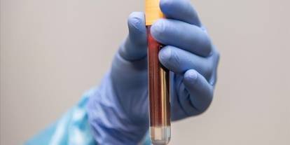 Kardeşi prostat kanseri olanlar dikkat!