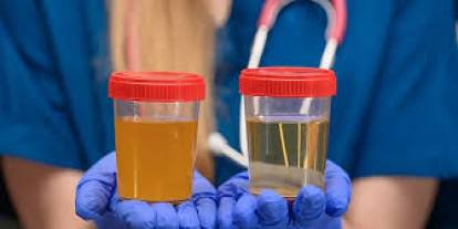 Koyu idrarı hafife almayın!