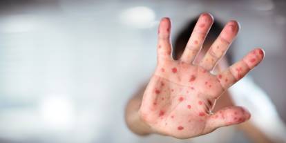 Uzmanı açıkladı! Aşı karşıtlığı o hastalıkta ölümcül sonuçlar doğurabiliyor