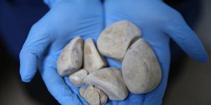 İdrar kanalı ve mesanesinden yarım kilogram taş çıktı