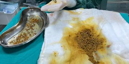 Karın ağrısı şikayetiyle gittiği hastanede safra kesesinden 2 bin 67 taş çıkarıldı