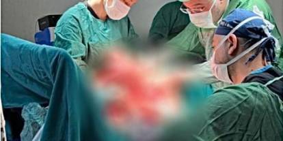 Sivas'ta bir hastanın göğsünden 7 kilo 750 gramlık tümör çıkarıldı