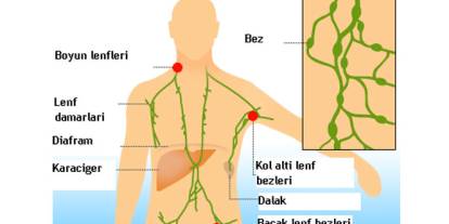Uzun süren ve büyüyen lenf bezleri mutlaka değerlendirilmeli