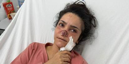 Eşi tarafından burnu ısırılıp koparıldı
